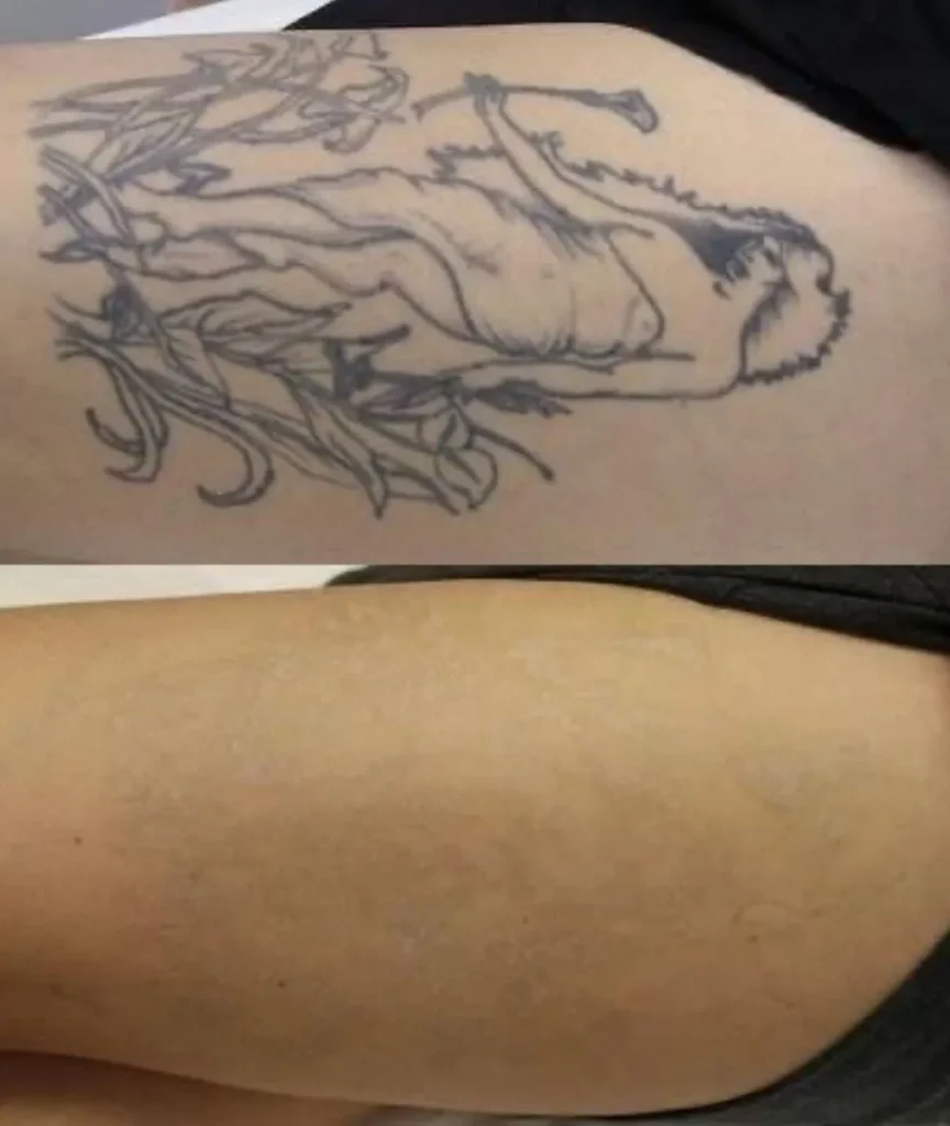 laser tattoo removal