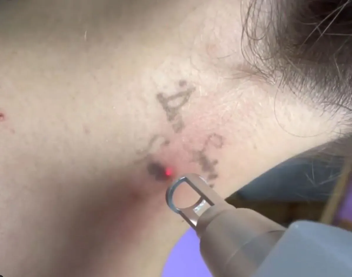 best tattoo removal melbourne