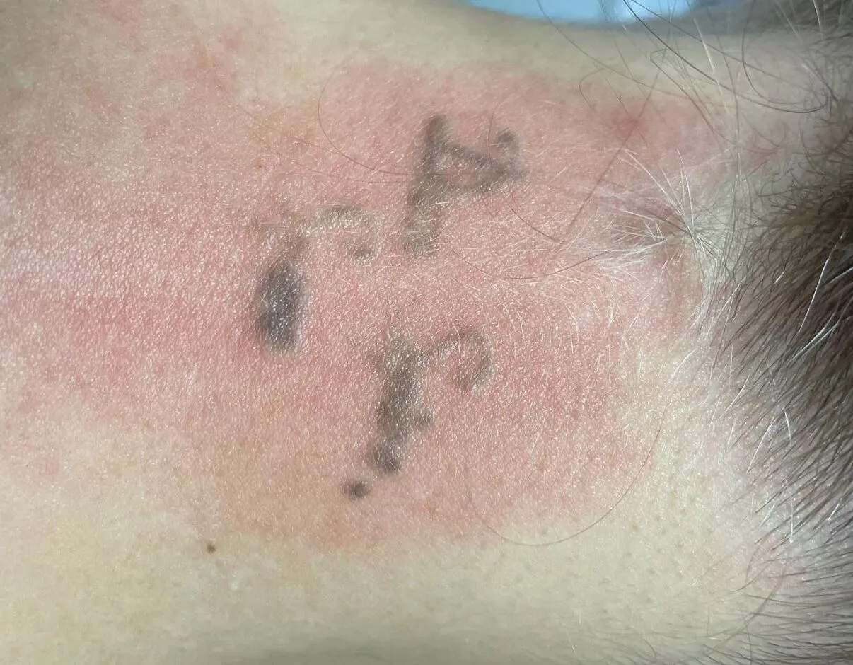 lazer tattoo removal