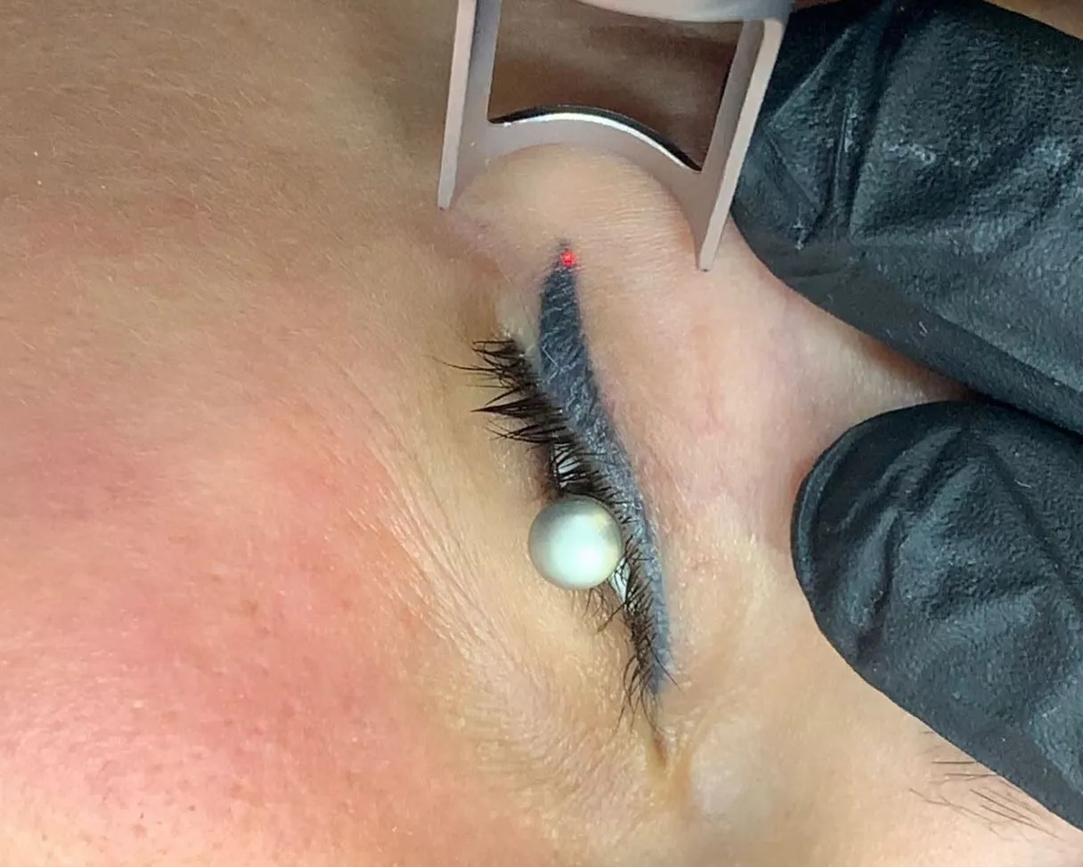 tattoo removal laser