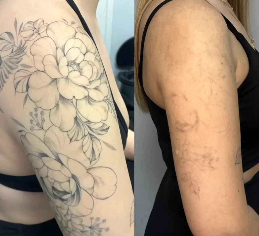 Why Does Tattoo Removal Cost So Much